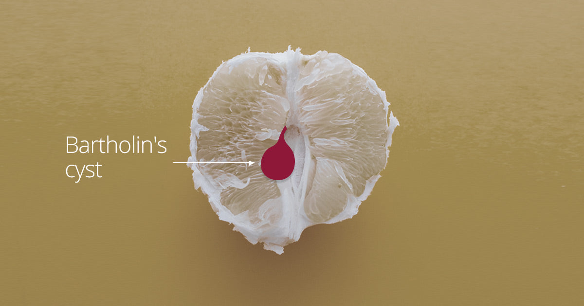 Bartholin's Cyst - Causes, Symptoms & How To Heal It? Carmesi Bartholin's Cyst - Causes, Symptoms & How To Heal It? Carmesi