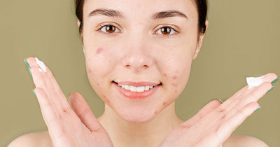 Period Acne: Causes, Types, Treatment - Taking Care of Your Acne During Period