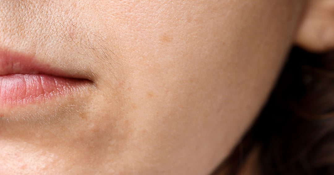 high testosterone in women