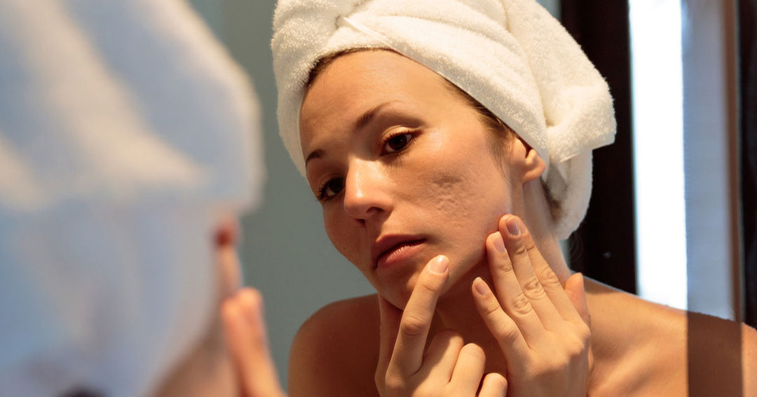 What are Blemishes, and How Can You Get Rid of Them?