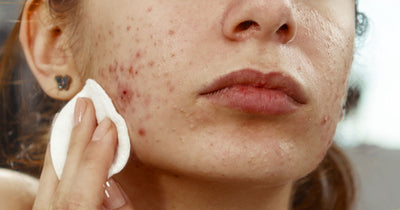 How Often Should You Wash Your Face if You Have Acne?