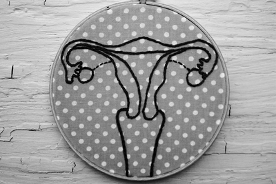 Endometriosis - What is it, Symptoms, Causes & Treatment