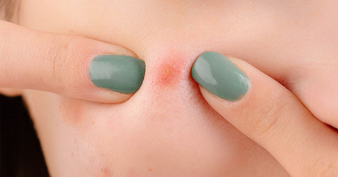 The Acne Diet: What You Can Eat To Prevent Acne