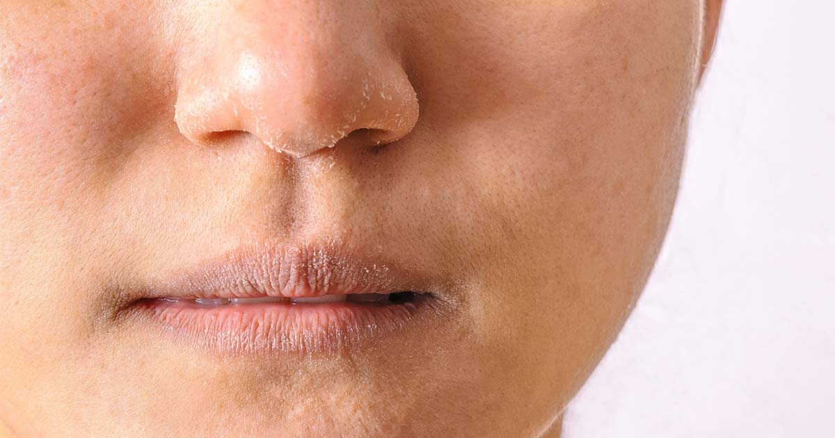 Dry Skin on the Face: Common Causes and Proven Remedies