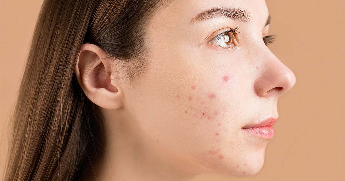Cystic Acne: What Is It, Symptoms, Causes and Treatment – Carmesi