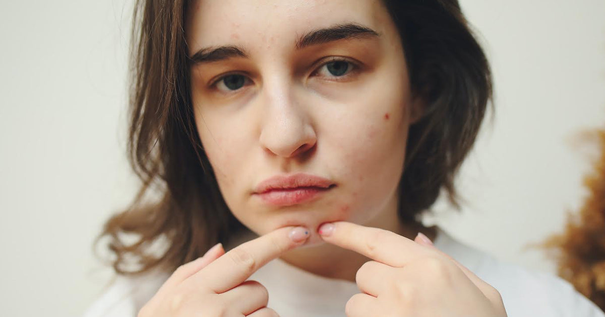 Hormonal Acne - Causes & Symptoms, Acne Treatment & Prevention