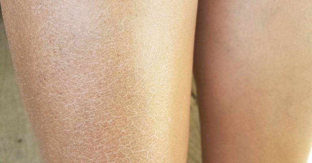 Dry Skin on Legs: Causes and How to Find Relief from Dry, Flaky Legs