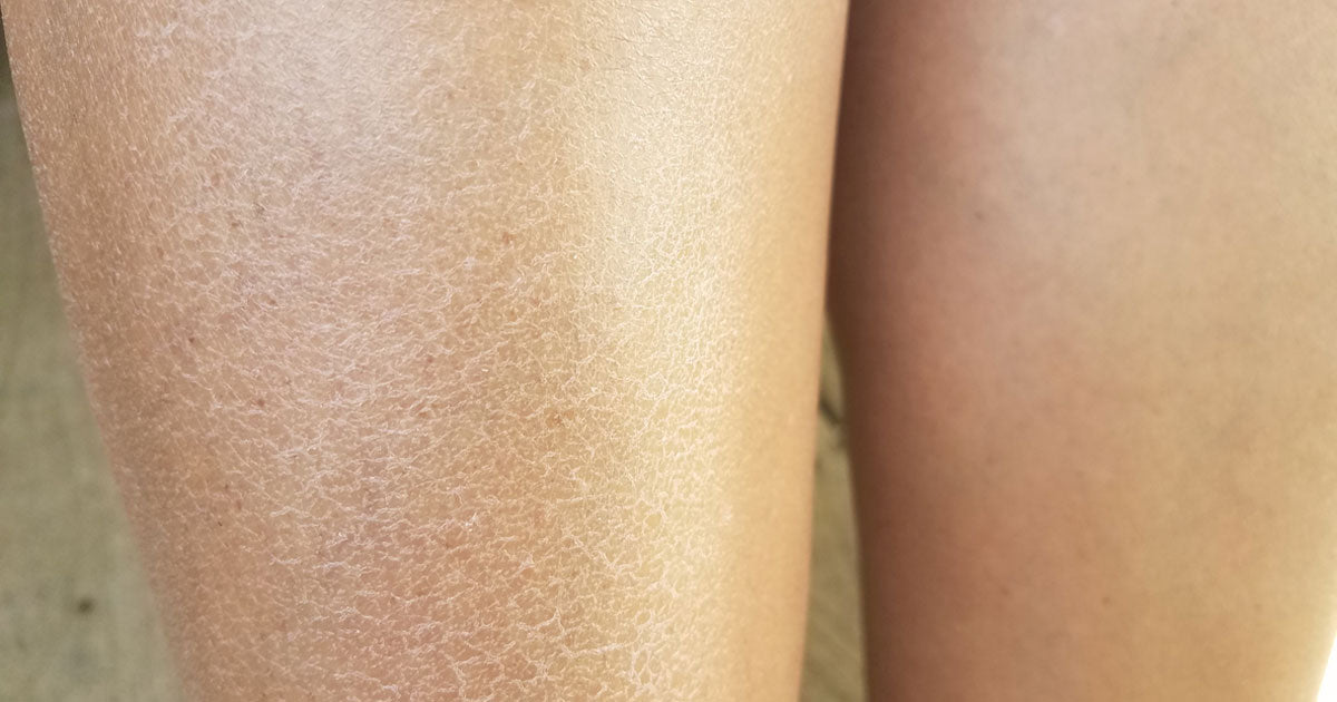Dry Skin on Legs: Causes and How to Find Relief from Dry, Flaky Legs