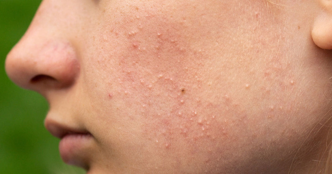 Clogged Pores: How to Get Rid of Clogged Pores: 5 Proven Tips