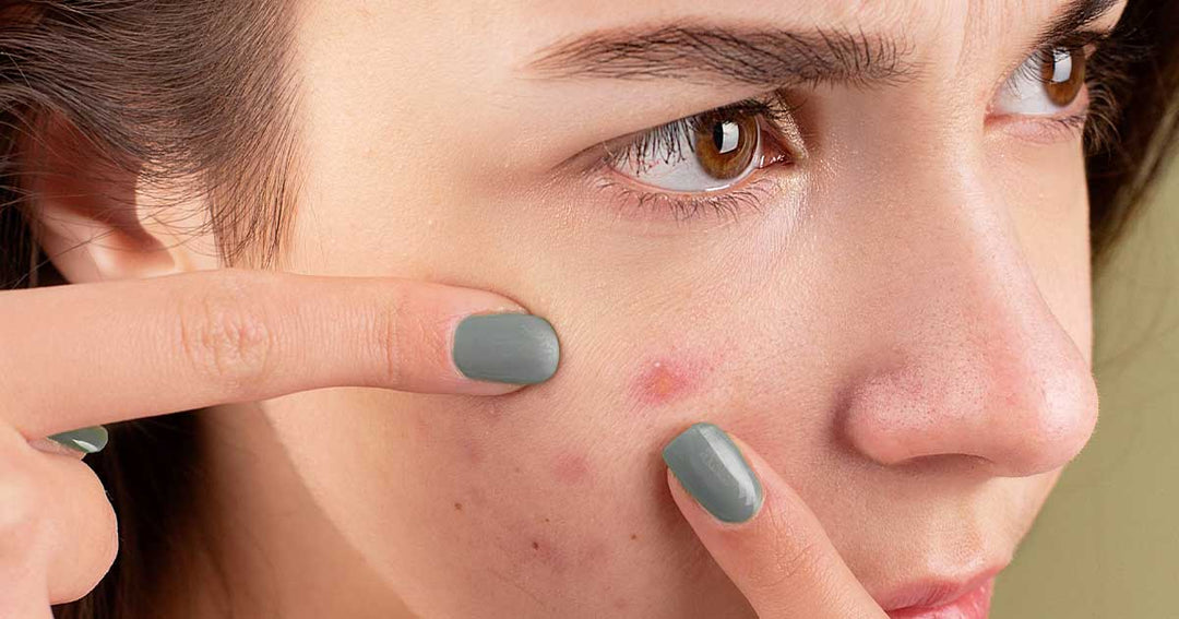 Hormonal Acne Care: DIY Tips That Truly Work!