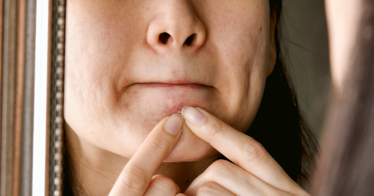 Blackheads vs Whiteheads: How to Treat Each the Right Way