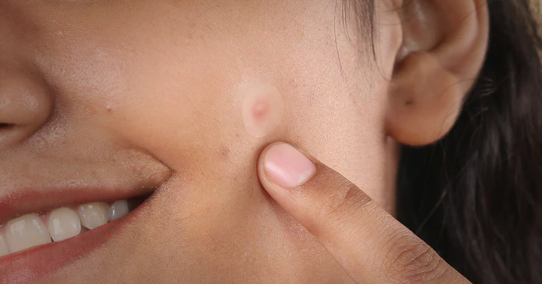 Do Pimple Patches Help Fade Acne Scars and Dark Spots? What the Science Actually Says