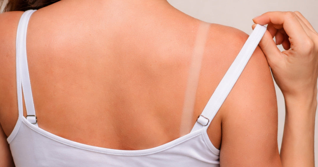Guide to Bra Strap Marks: Causes, Prevention & Relief