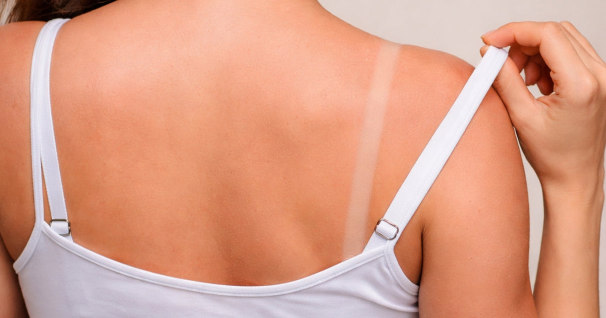 Guide to Bra Strap Marks: Causes, Prevention & Relief