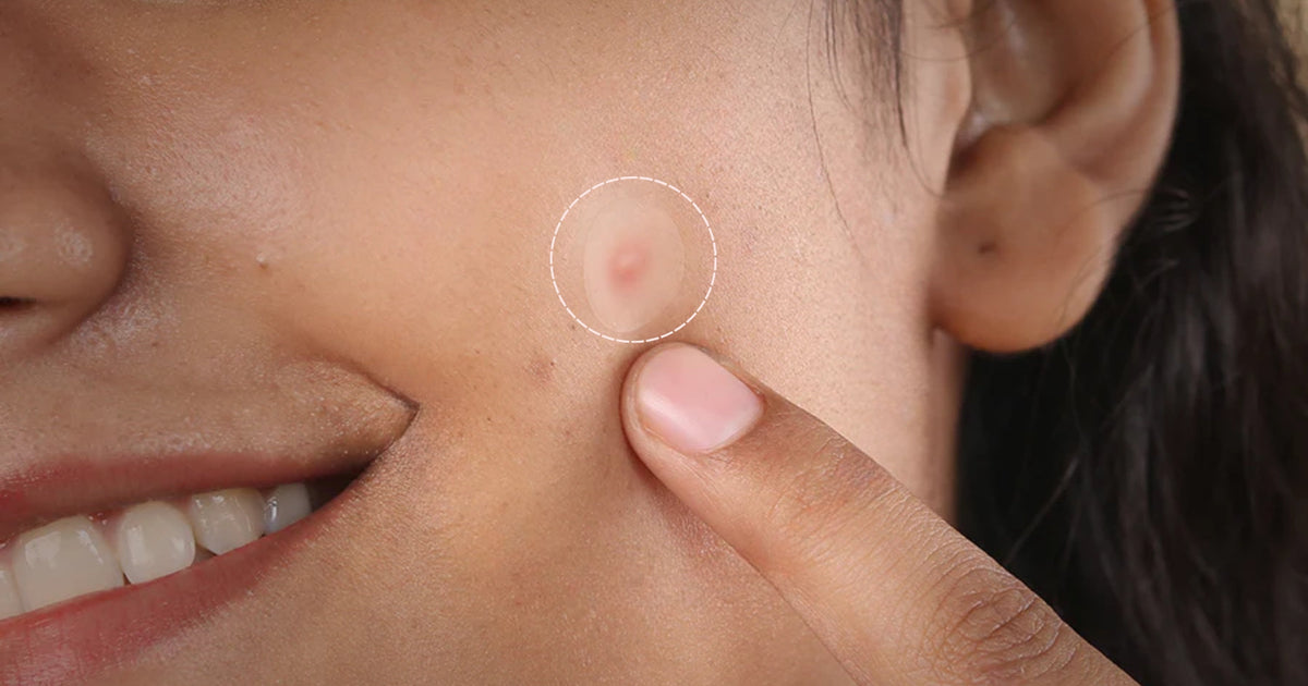How Do Pimple Patches Work? Pimple Patch Uses, Benefits & Effectiveness