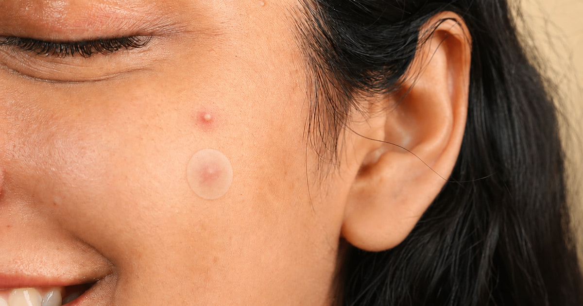 Hydrocolloid Pimple Patches: The Science Behind How They Draw Out Fluid and Heal Skin