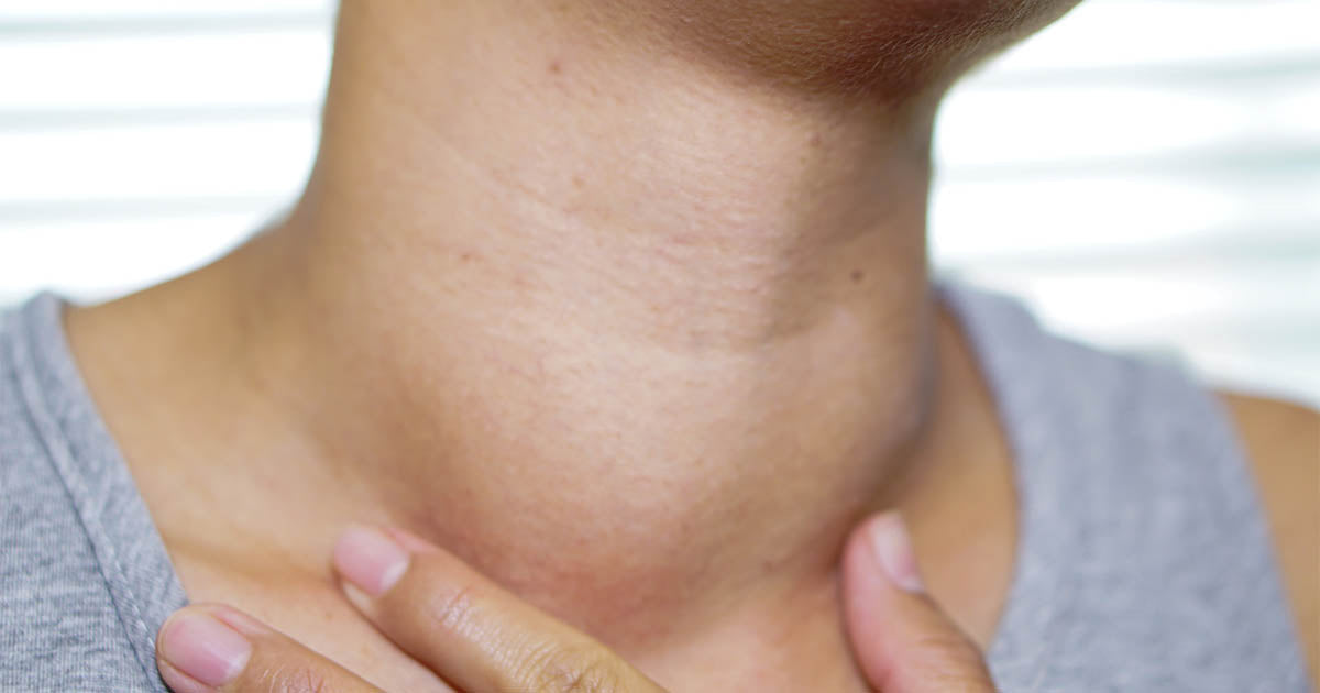Symptoms of Iodine Deficiency
