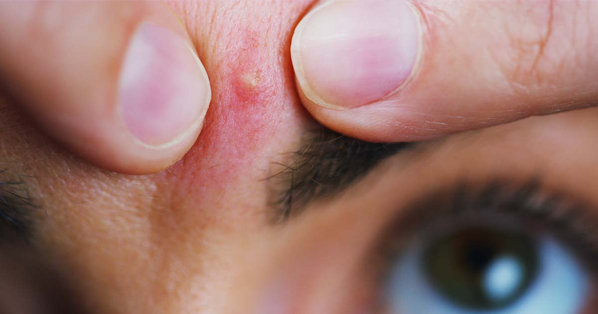 Why do I Have Acne Between My Eyebrows?