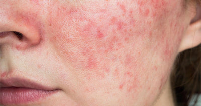 What is Rosacea and Can You Treat It?