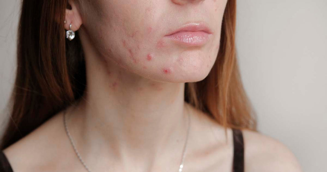Acids in Acne Care: Benzoyl Peroxide