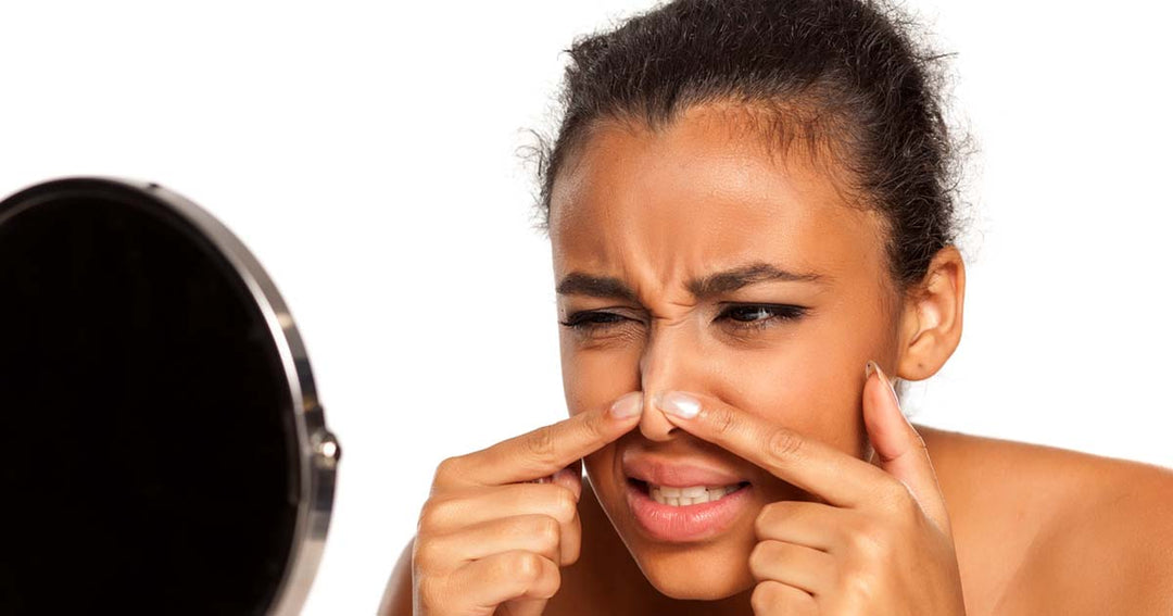10 Tips for Clearing Acne in Darker Skin Tones