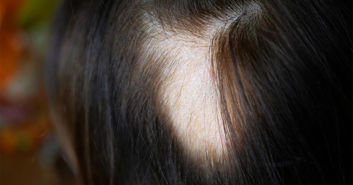 5 common scalp issues that are NOT dandruff