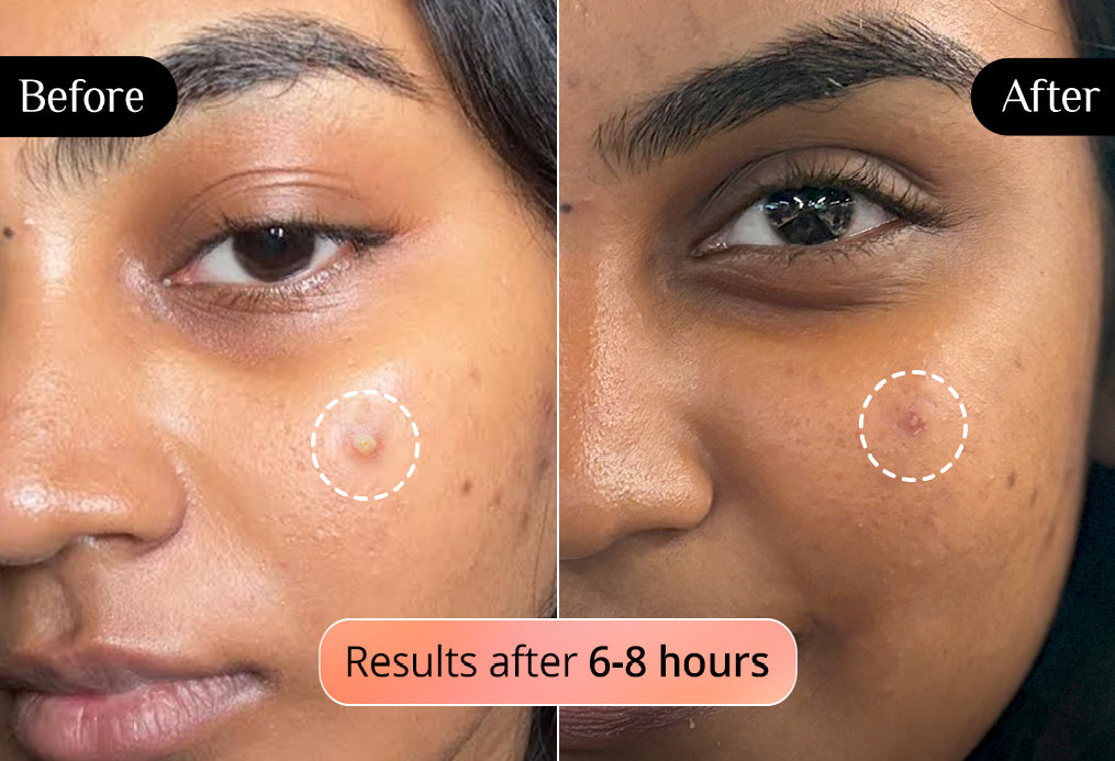 Carmesi Natural Deodorant Roll-on (Fresh Blossom) + Carmesi Pimple Patches