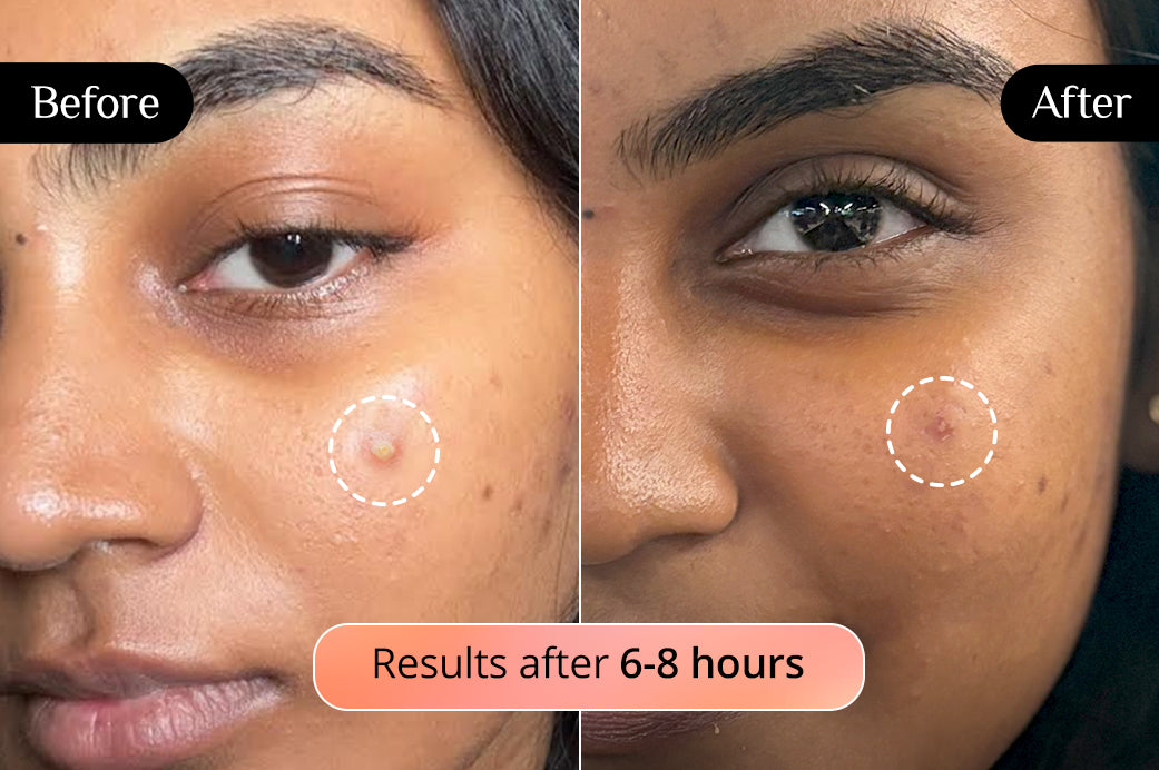 Carmesi Pimple Patch
